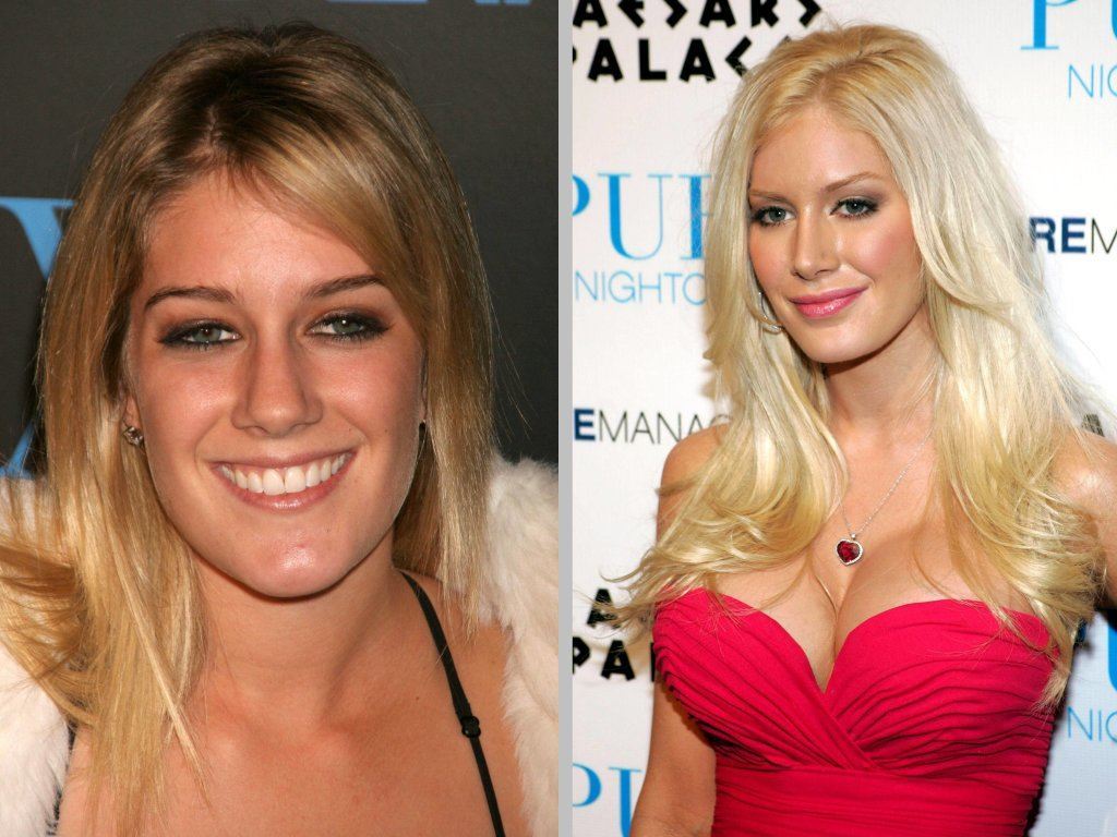 bad celebrity plastic surgery