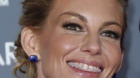 famous faces who wore adult braces