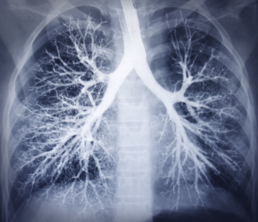 Chest X-Ray of Lungs